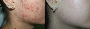 acne_webaft